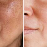 before after 02 peel f p