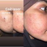 co2 acne