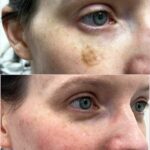 cryo before and after