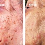 cryotherapy before and after age spots treatment