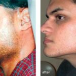 laser hair removal before after men1