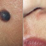 specialised care scarless mole removal